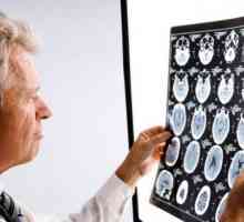 Neurologie: simptome cerebrale de leziuni ale creierului