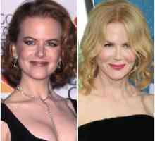 Nicole Kidman: înainte și după plastic (fotografie)