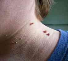 Neoplasme pe piele: tipuri, cauze de dezvoltare, diagnostic, tratament, prevenire