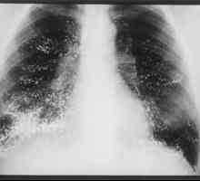 Pneumonia nozocomială: agenți patogeni, tratament și prevenire