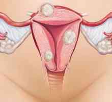Durere foarte severă cu menstruație: cauze, tratament