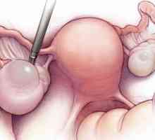Operație pentru eliminarea chistului ovarian