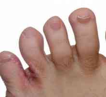 Fractura dintre degetele de la picioare: cauze, simptome și caracteristici de tratament