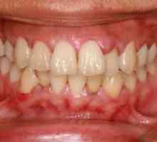Guma sa umflat, dar dintele nu durează - ce să facă sau să facă? Cauze de umflare a gingiilor și…