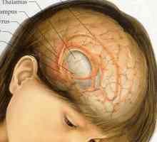Brain tumorii: simptome într-un stadiu incipient. Primele semne ale unei tumori cerebrale