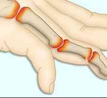 Principalele simptome ale artritei reumatoide