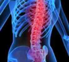 Osteofitele coloanei vertebrale. Osteofitele coloanei vertebrale cervicale