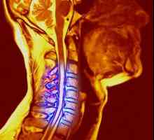 Osteocondroza secțiunii de col uterin de gradul 2: simptome, posibile cauze și particularități ale…