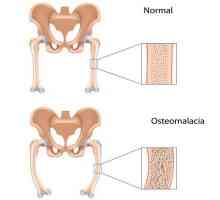 Osteomalacia: ce este, cauzele, simptomele, diagnosticul și trăsăturile de tratament