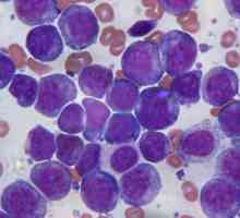 Leucemia acută a sângelui: câte persoane trăiesc, caracteristicile tratamentului și diagnosticarea