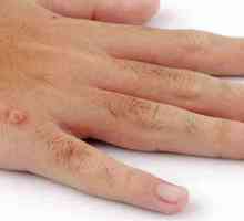 Ce cauzează negi pe mâini? De ce apar negii pe degetele copiilor?