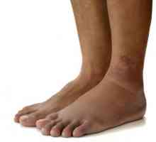 Edemul picioarelor în diabet: cauze posibile și caracteristici ale tratamentului