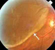 Detașarea retinei, intervenția chirurgicală: recenzii. Cum funcționează, recuperarea