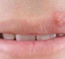 Papilomii din gură: cauze, tratament, îndepărtarea cu laser