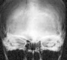 Fractura de baza a craniului. Imagine clinică