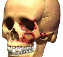 Crăpăturile craniului: tipuri, simptome, tratament și consecințe