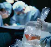 Transplantul de rinichi: o operație în care se face, viața după intervenție, o coadă