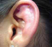 Perichondrita urechii: simptome, tratament, fotografie
