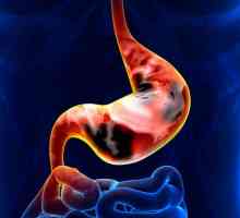 Carcinomul inelar al stomacului: simptome, prognostic și caracteristici de tratament