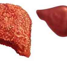 Simptome primare de hemoroză