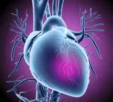 Primele simptome ale atacului de cord la femei și bărbați