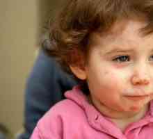 Alergia alimentară la copii: simptome, tratament și consecințe