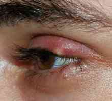 Pisyak pe ochi: simptome, tratament, prevenire