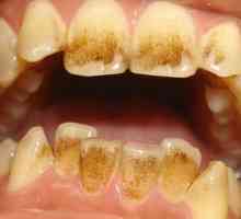 Spoturi din cafea pe dinți: cauze și metode de eliminare