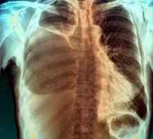 Pleurisia cu cancer pulmonar: descriere, cauze, simptome și tratament