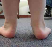 Ploskovolgusnye picioare la copil. Metode de tratament