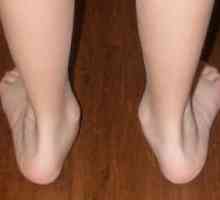 Din ce motiv se dezvoltă picioarele flat-valgus la copii și cum să le tratezi?