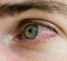 De ce sunt ochii roșii și cum se elimină disconfortul?