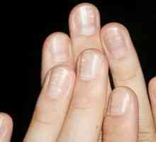 De ce sunt petele albe pe unghii: motivele cele mai probabile
