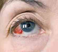 De ce ochii izbucnesc vasele de sange: cauzele si tratamentul