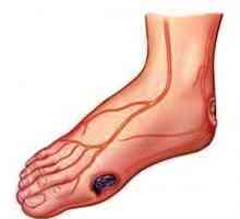 În detaliu despre ce și cum să tratezi ulcerul trofic pe picioare