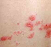 Petele roșii apar pe piele și provoacă mâncărime: cauze și tratament