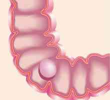 Polyp în intestine: simptome și tratament, chirurgie pentru a elimina