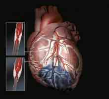 Postinfarcție cardioscleroză ICD 10