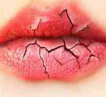 Buzele crăpate: cauze și metode de tratament