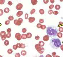 Monocite crescute în sânge - ce înseamnă asta?