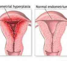 Medicamentul "Norkolut": recenzii. Cu hiperplazia endometrială, cum să luați Norkolut? Ce…