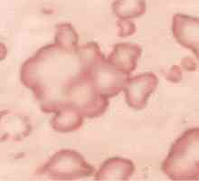 Cauzele și tratamentul eczemelor microbiene: unguente, fotografii