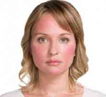 Cauzele couperozei pe față și căile de tratament