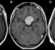 Cauzele meningiomului creierului. Tratament, prognoză, funcționare și consecințe