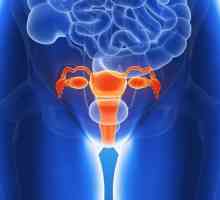 Cauze, simptome și tratamentul polipilor în uter