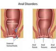 Cauzele și simptomele fisurilor anale. Furia anală: metode de tratament cu remedii folclorice