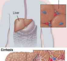 Semne ale hepatitei C la bărbați. Simptome, tratament, prevenire