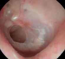 Ulcerul perforat: simptome și tratament