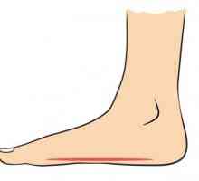 Picior longitudinal 2 picioare: diagnoză, trăsături de tratament