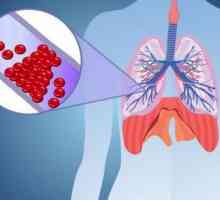 Prevenirea tromboembolismului arterei pulmonare